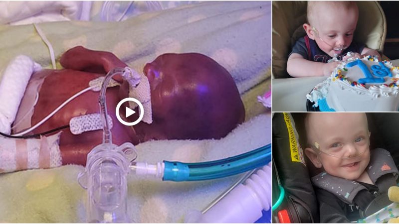 World’s smallest premature baby celebrates first birthday with 0% chance of a surprise today