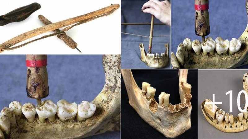 Early Evidence of Dentistry: Neolithic Teeth Unveil Ancient Dental Practices at Mehrgarh