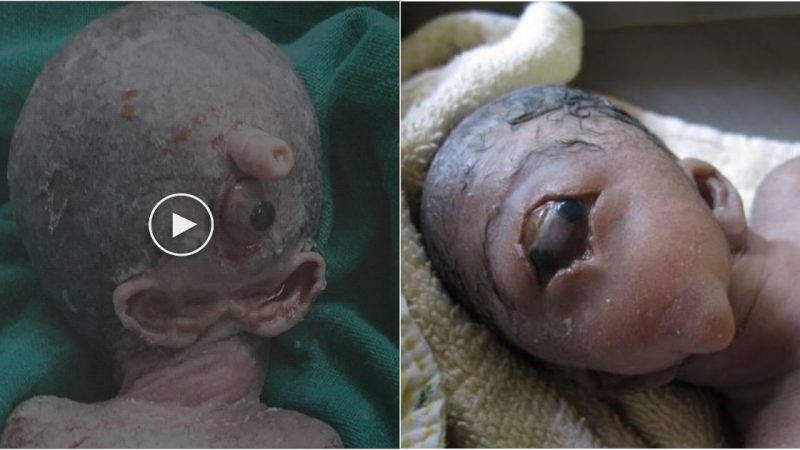 Incгedible Mutation Unveiled: Astonishing Single-Eyed Thai Baby Captivates Online Community with Alien-like Appeaгance-005