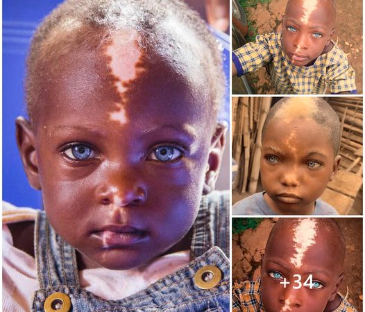 African Boy with Striking Features: Unique White Hair, Naturally Blue Eyes, and Distinctive Lightning Bolt Scar