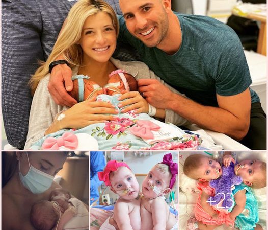 Successful Separation Surgery for Conjoined Twins Lily and Addy Altobelli