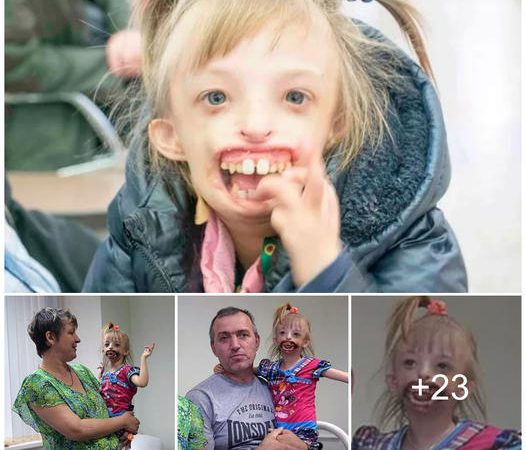 A Remarkable Journey: Unconditional Love and Acceptance for a 3-Year-Old with Half a Face