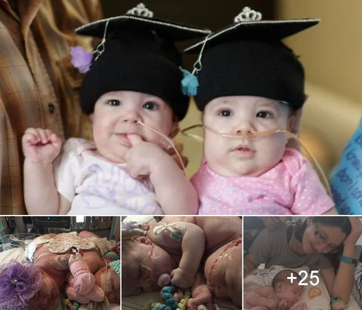 A Heartwarming Journey: Conjoined Twins Separated and Welcomed Home