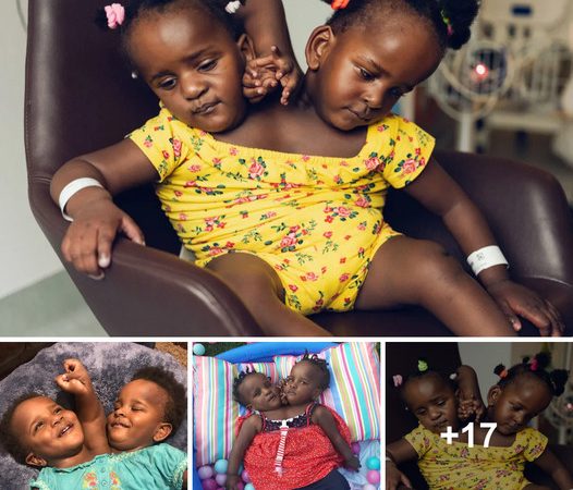 Unbreakable Bonds: Conjoined Twins’ Inspiring Journey of Triumph