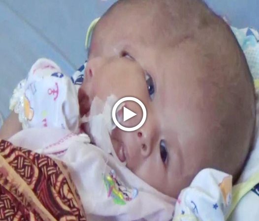 Parents Pray for a Miracle as Their Baby is Born with Two Faces